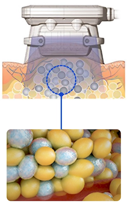 Cryolipolysis 2-INNO-IMG