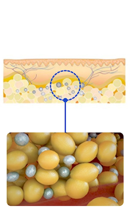 Cryolipolysis 3-INNO-IMG