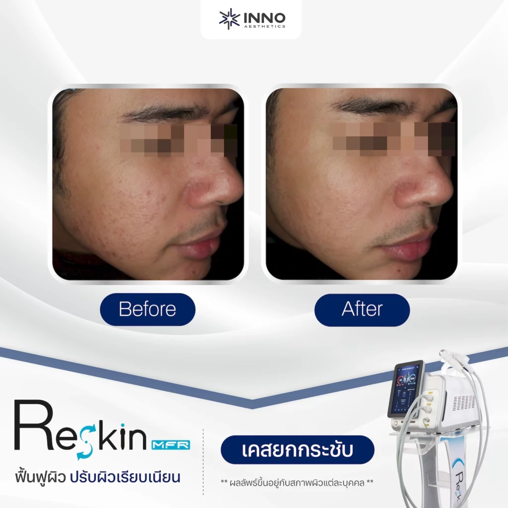 microneedle RF Before After