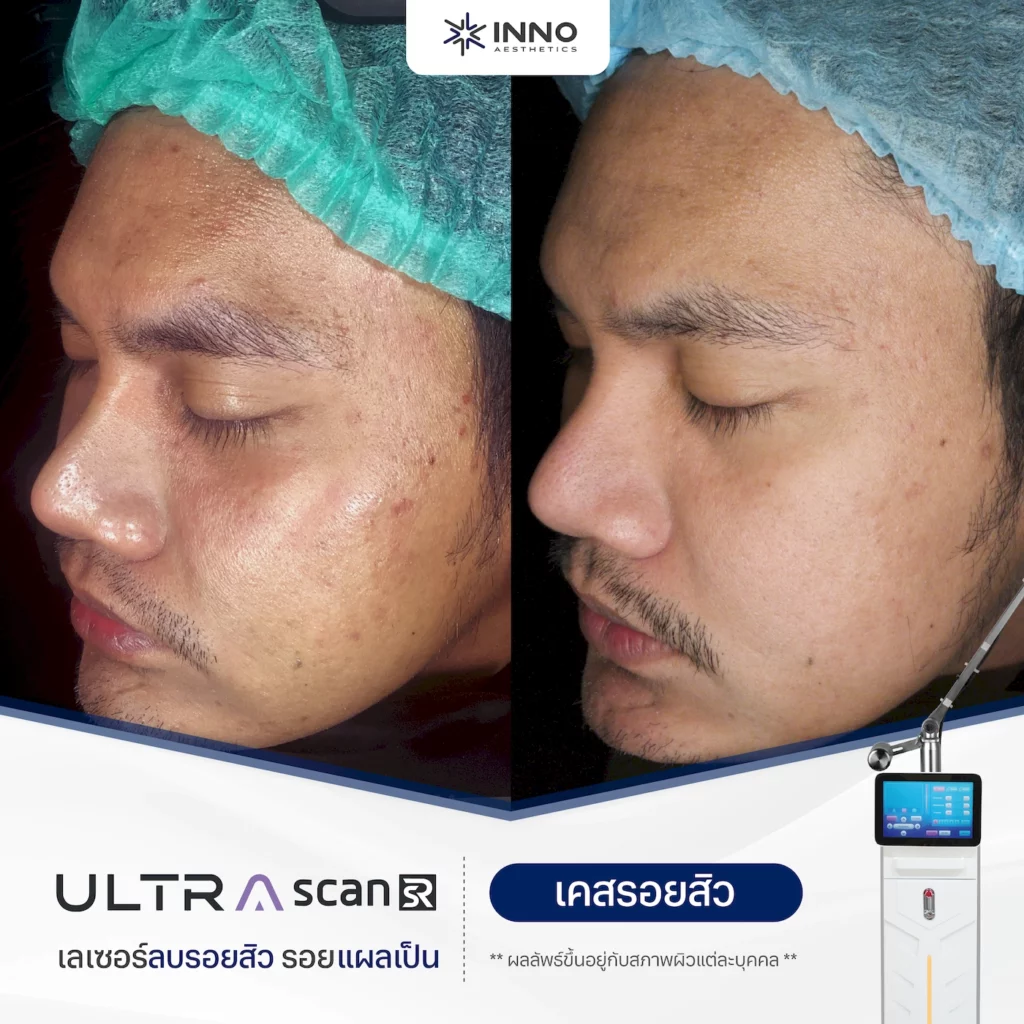 Fractional Co2 Laser รีวิว