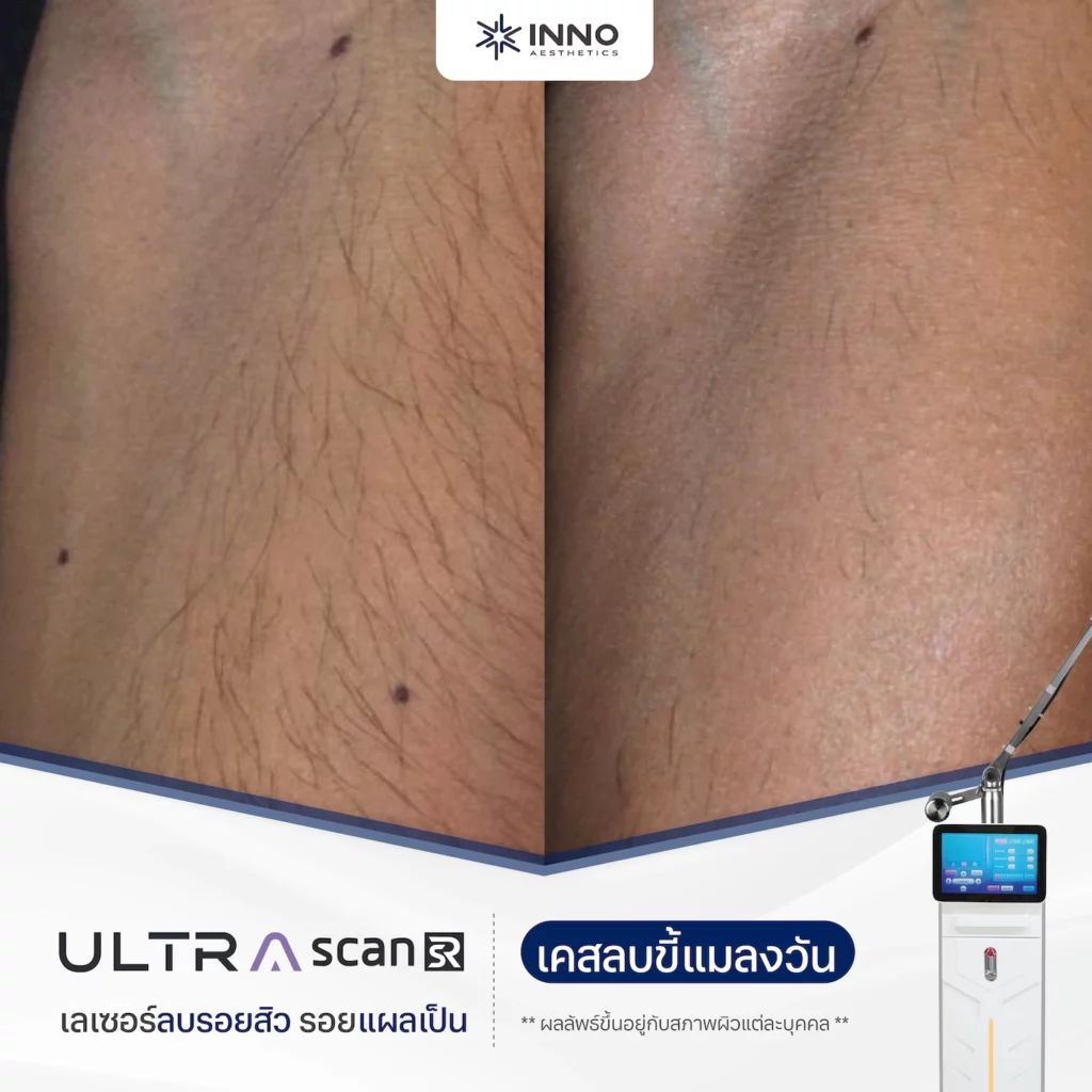 Fractional Co2 Laser รีวิว 2