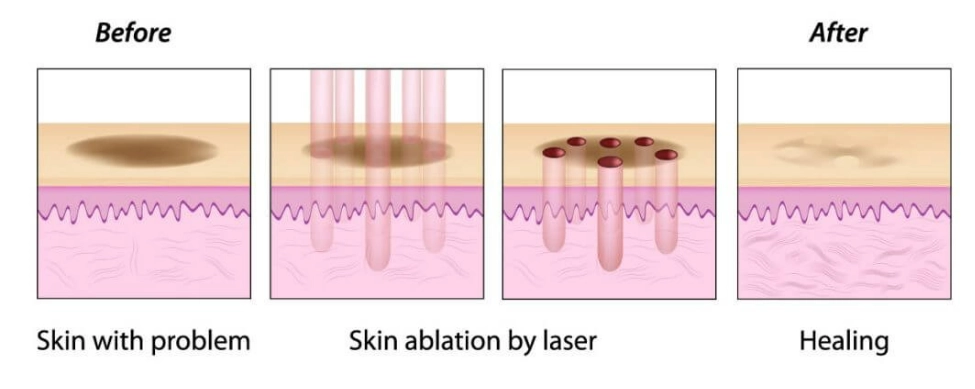 fractional-co2-laser-mole-removal-review_co2-4-INNO-IMG