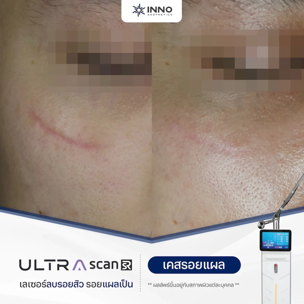 Fractional Co2 Laser รีวิว 3