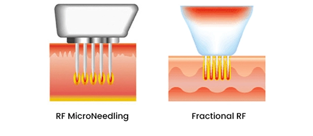 fractional-microneedle-rf-clear-acne-scars-smooth-skin-img1-n-INNO-IMG