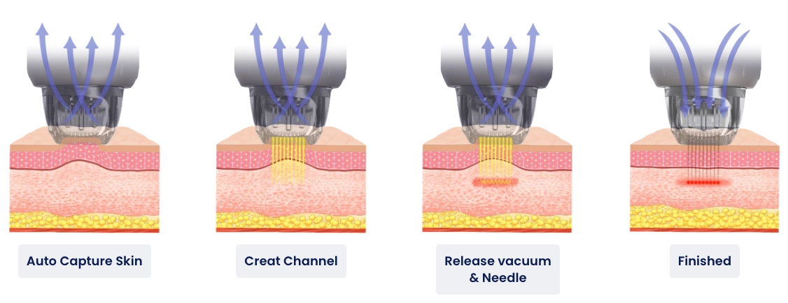 รูปการทำงาน Micro Needle RF และ Fractional Microneedle RF