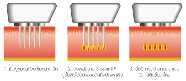 fractional-microneedle-rf-clear-acne-scars-smooth-skin-img2-n-INNO-IMG