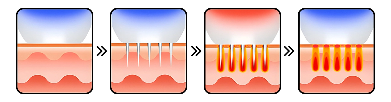 รูปการทำงาน Micro Needle RF และ Fractional Microneedle RF